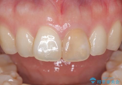 前歯の変色を改善し、本来の自然な美しさへの症例 治療前