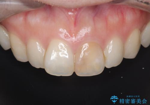 前歯の変色を改善し、本来の自然な美しさへの治療前