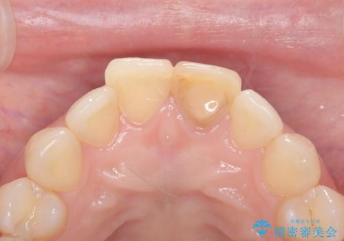 前歯の変色を改善し、本来の自然な美しさへの治療前