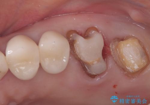 難症例の奥歯も3ヶ月で機能回復!抜歯即時インプラントでスピード解決の治療前