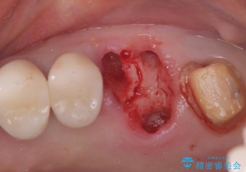 難症例の奥歯も3ヶ月で機能回復!抜歯即時インプラントでスピード解決の治療前