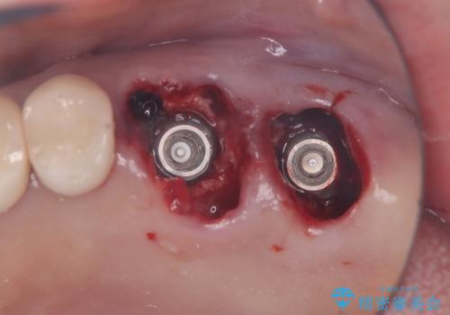 難症例の奥歯も3ヶ月で機能回復!抜歯即時インプラントでスピード解決
