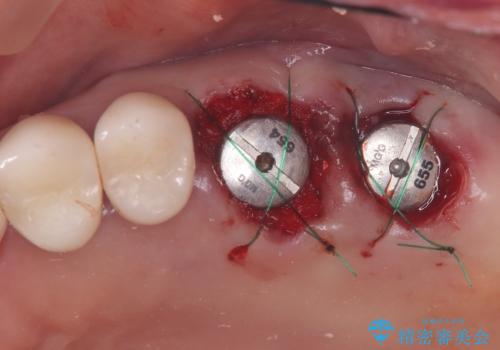 難症例の奥歯も3ヶ月で機能回復!抜歯即時インプラントでスピード解決の治療後