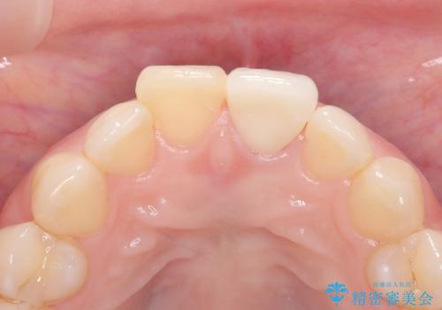 前歯の変色を改善し、本来の自然な美しさへの治療後