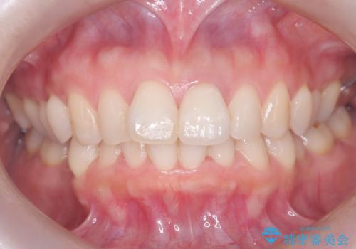 前歯の変色を改善し、本来の自然な美しさへの治療後