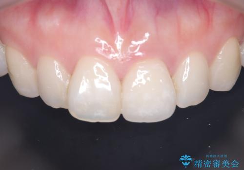 前歯の変色を改善し、本来の自然な美しさへの治療後