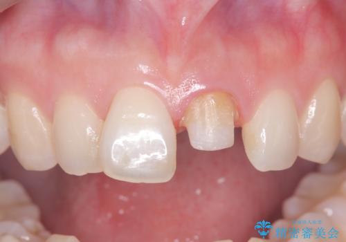 前歯の変色を改善し、本来の自然な美しさへの治療中
