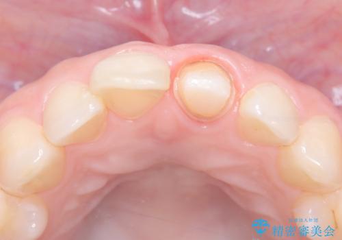 前歯の変色を改善し、本来の自然な美しさへの治療中