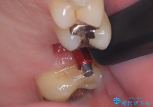 顕微鏡で確認した歯の破折。抜歯即時インプラントで治療の治療中