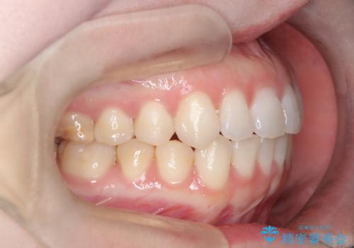 審美ワイヤー矯正とTAD併用による犬歯の遠心移動の治療後