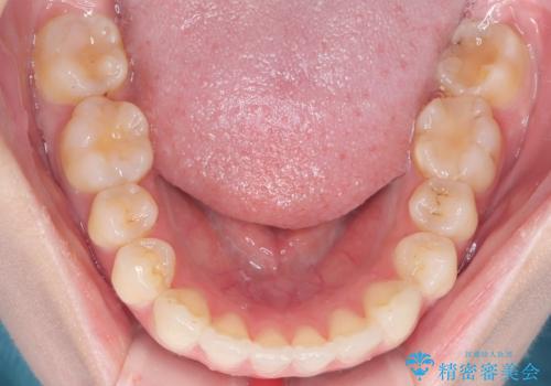 審美ワイヤー矯正とTAD併用による犬歯の遠心移動の治療後