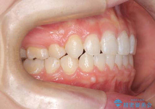 八重歯と歯のズレを解消し、整った笑顔への治療後