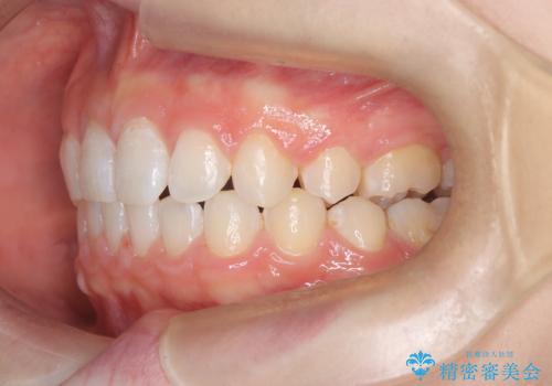 八重歯と歯のズレを解消し、整った笑顔への治療後