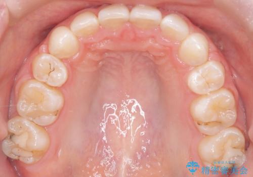 八重歯と歯のズレを解消し、整った笑顔への治療後