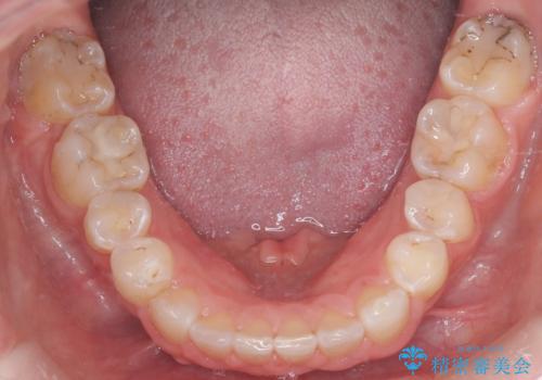 八重歯と歯のズレを解消し、整った笑顔への治療後