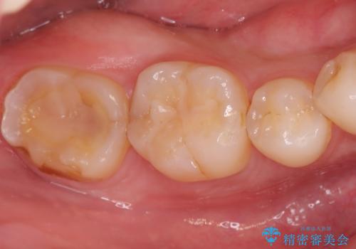 セラミッククラウンによる奥歯の修復の症例 治療前