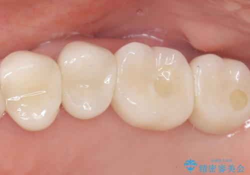 難症例の奥歯も3ヶ月で機能回復!抜歯即時インプラントでスピード解決の治療後
