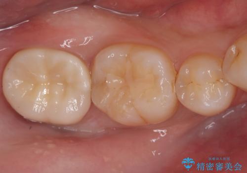 セラミッククラウンによる奥歯の修復の症例 治療後