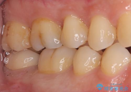 セラミッククラウンによる奥歯の修復の治療後