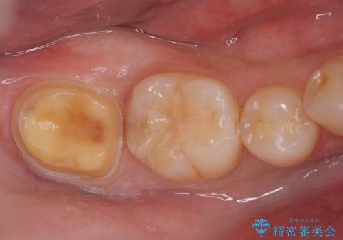 セラミッククラウンによる奥歯の修復の治療中