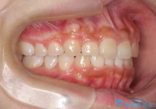 目立たない矯正で中等度の叢生を改善の治療後