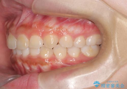 目立たない矯正で中等度の叢生を改善の治療後