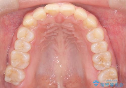 目立たない矯正で中等度の叢生を改善の治療後