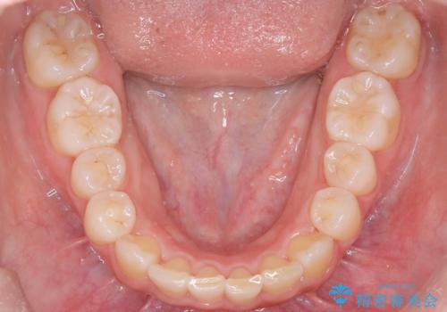 目立たない矯正で中等度の叢生を改善の治療後