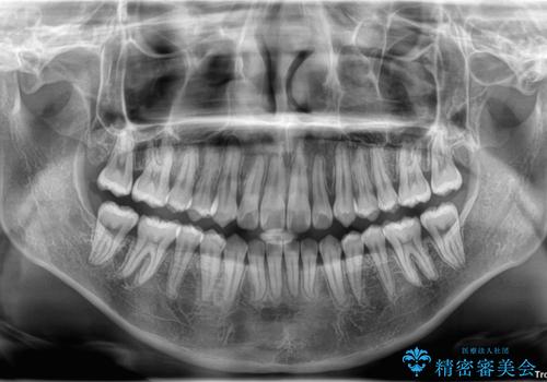 【モニター】前歯のデコボコをスッキリ解消!目立ちにくいワイヤー矯正でスピーディに治療完了の治療後
