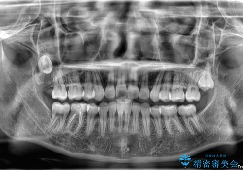 転勤でも安心して治療継続 抜歯スペース閉鎖と深い噛み合わせ改善のワイヤー矯正の治療後
