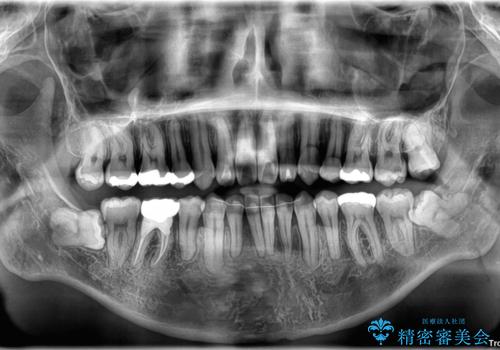 口元の突出感を改善!目立ちにくいワイヤー矯正で自信を持てる自然な横顔にの治療後