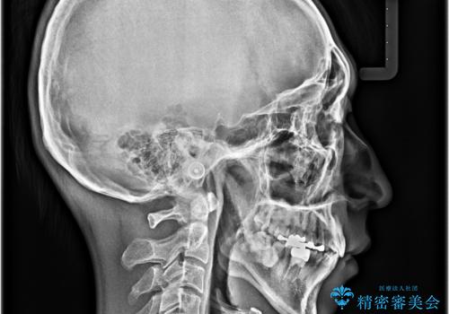 口元の突出感を改善!目立ちにくいワイヤー矯正で自信を持てる自然な横顔にの治療後