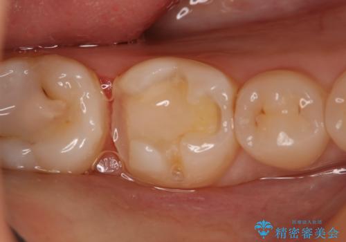 奥歯の虫歯を直したい セラミックインレーの治療中