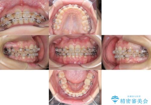 歯のデコボコ|口ボコ|八重歯が気になる!|ワイヤー矯正の治療中