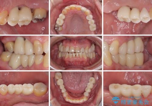 欠損の多い奥歯 インプラントによる補綴治療の治療後