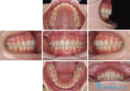 出っ歯を治したい ワイヤー装置での抜歯矯正の治療後