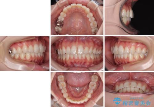 マウスピースが面倒くさい インビザラインでできるところまで頑張った矯正治療の治療後