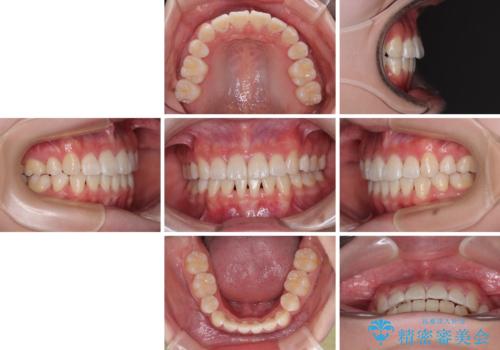 【モニター】とがった口元を抜歯して改善 ワイヤー装置の矯正治療の治療後