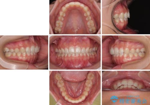 補助装置を併用して確実に インビザラインで奥歯の咬み合わせをしっかりと改善の治療後