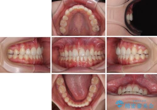 飛び出した前歯 インビザラインを用いた抜歯矯正治療の治療後