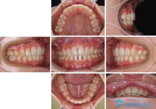 急速拡大装置 狭い骨幅を拡大した上で、口元の突出感を改善する抜歯矯正治療の治療後