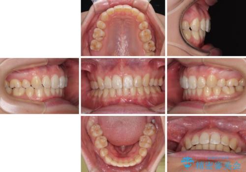 上の前歯が下唇に引っかかる 口元を引っ込めすぎない抜歯矯正治療の治療後