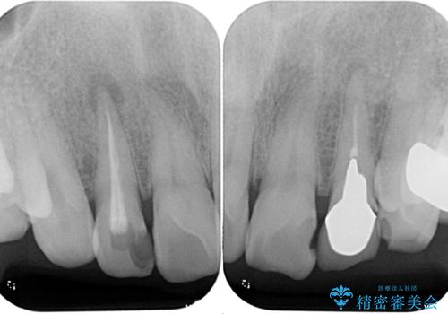前歯の色味を治したい オールセラミッククラウンの治療前