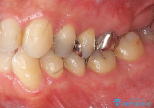 矯正と虫歯のセラミック治療 総合歯科治療の実践の治療前