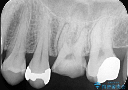 顕微鏡で確認した歯の破折。抜歯即時インプラントで治療の症例 治療前