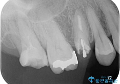 奥歯の根の病変も精密治療で解決の治療前