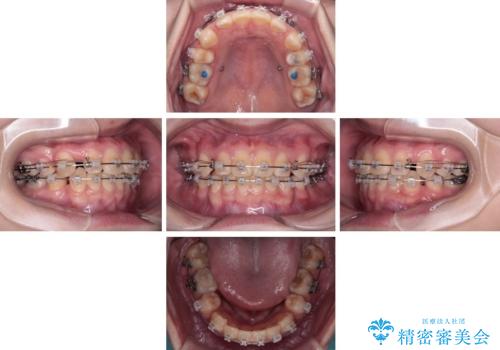 転勤でも安心して治療継続 抜歯スペース閉鎖と深い噛み合わせ改善のワイヤー矯正の治療中