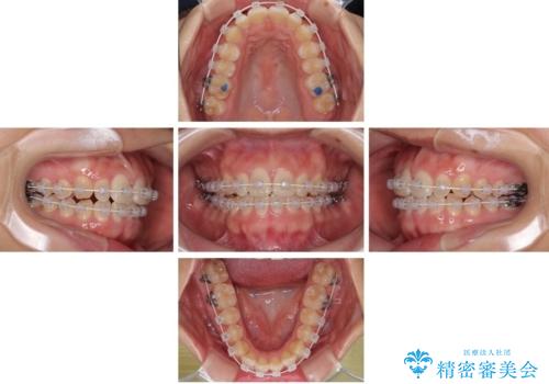 目立ちにくい表側装置で1年完了!狭いアーチを側方拡大し前歯のデコボコを整えた症例の治療中