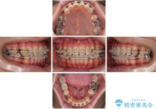 口元の突出感を改善!目立ちにくいワイヤー矯正で自信を持てる自然な横顔にの治療中