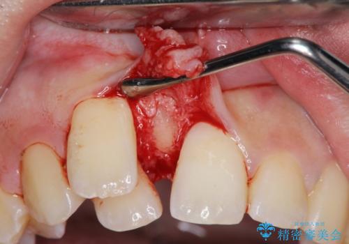 正中過剰埋伏歯で生じた前歯の審美障害 矯正治療での改善の治療前